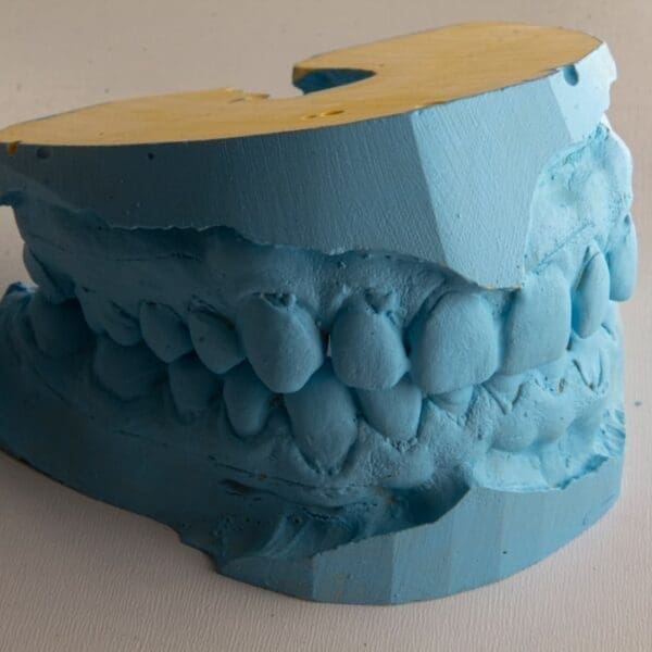 Improving Sleep with a Mandibular Advancement Device